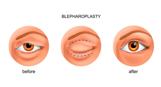 blepharoplasty graphic