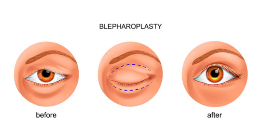 blepharoplasty graphic before and after