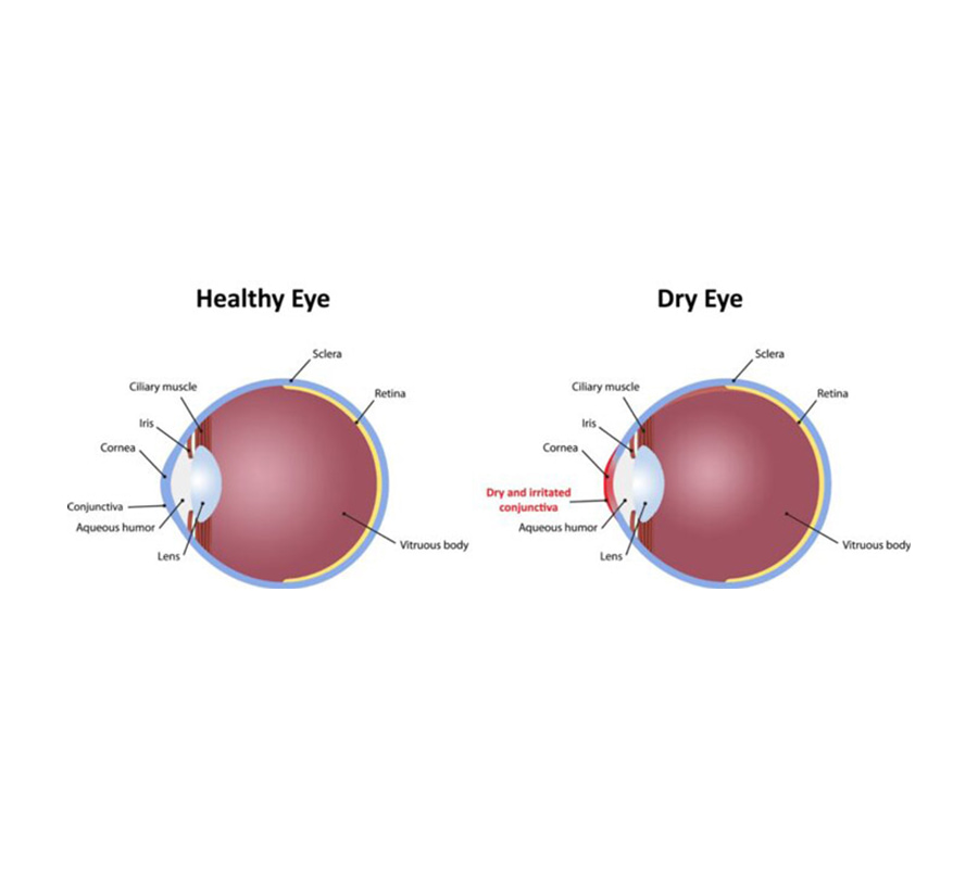 dry eye chart