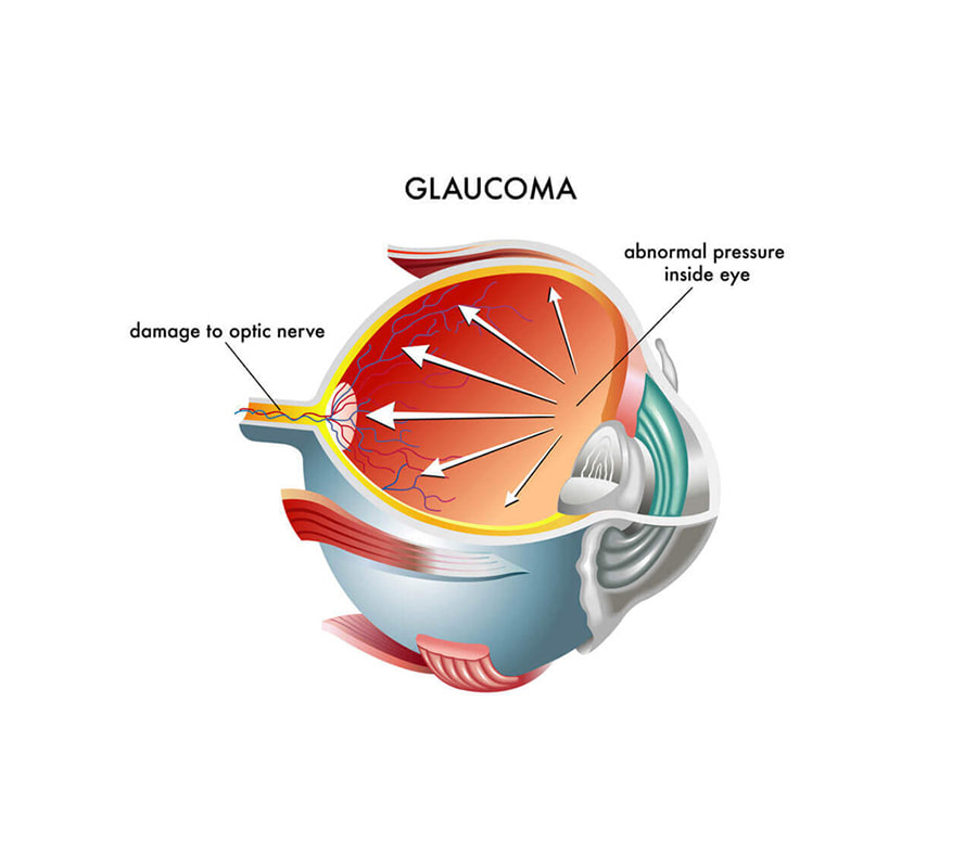 glaucoma chart