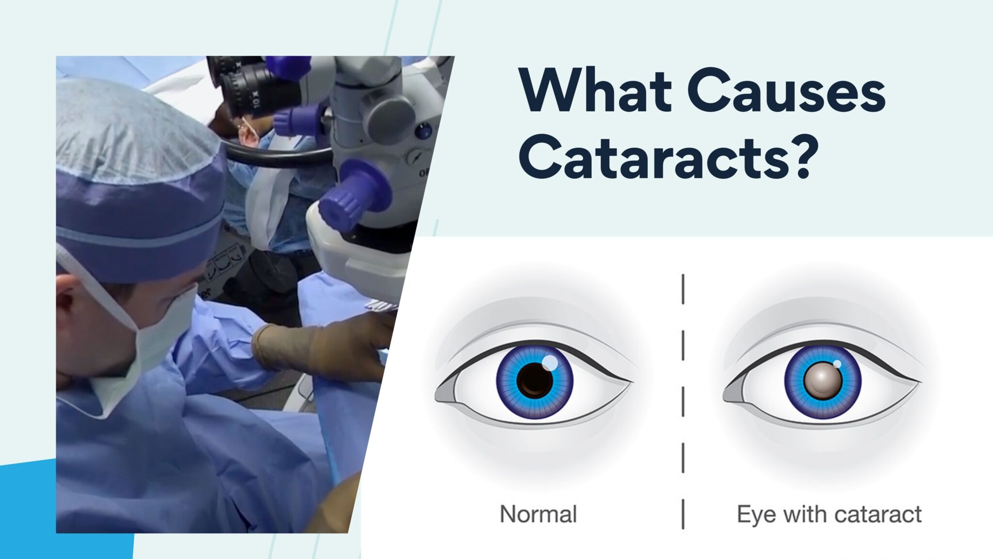 What Causes Cataracts? | Parkhurst NuVision LASIK Eye Surgery