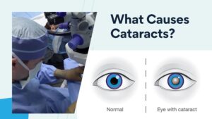what causes cataracts blog post image